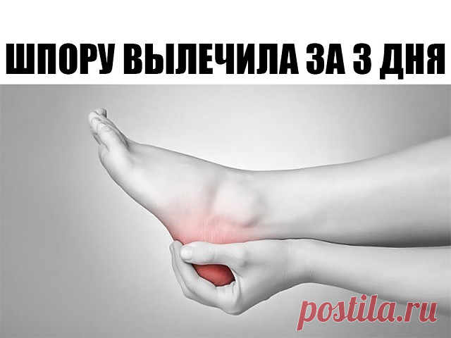 Поделюсь рецептами от пяточных шпор.
