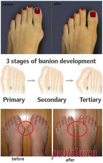 How to Prevent and Treat Bunions - AllDayChic A bunion is a deformity of the great toe characterized by a lateral deviation of it. People usually confuse it with bone growth, but it’s not that, it’s the bones that from wrong shoes or any abnormal pressure applied on the big side of the toe force them to get out from their normal position. …