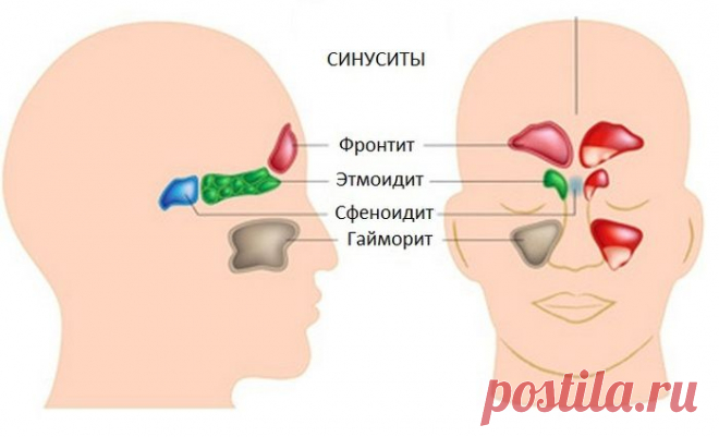 Синусит - симптомы, лечение, причины, диагностика и профилактика
