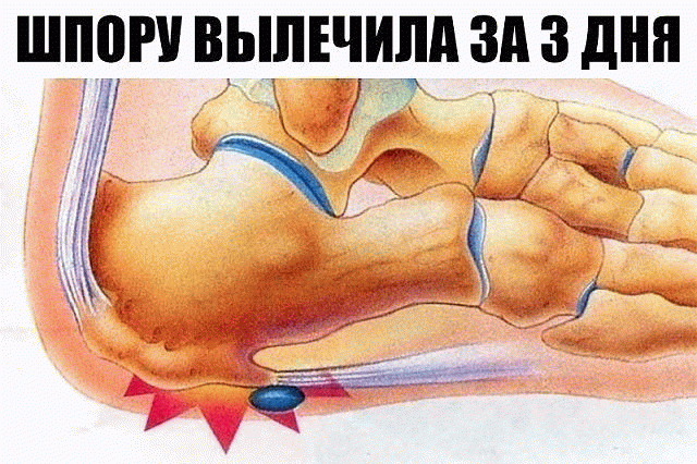 ШПОРУ ВЫЛЕЧИЛА ЗА 3 ДНЯ
Поделюсь рецептами от пяточных шпор. Прошлым летом на юге после ванн у меня так разболелась нога, что я не знала, куда ее деть. Пятка горела огнем. Приехав домой, побежала к хирургу. Молодая врач сделала снимок и объявила, что у меня после ванн обострилась пяточная шпора. Дала мне какую-то «памятку» - и все. Я поняла, что надо самой лечиться. Обратилась к народной медицине - стала искать рецепты от шпор. Все, что нашла, выписала и посылаю вам. Ведь сколько еще таких как