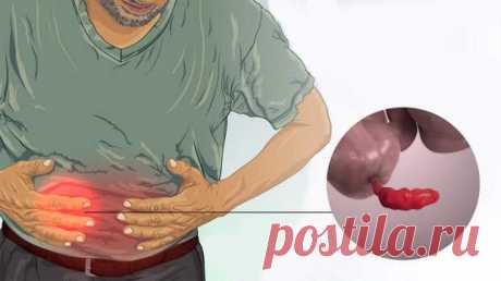 Первые симптомы и признаки аппендицита - ПолонСил.ру - социальная сеть здоровья - Медиаплатформа МирТесен Аппендицит может начаться в самый неподходящий момент: во время похода или круиза в открытом море. Главное при этом - вовремя узнать болезнь и обратиться за помощью к врачу. Что это такое? Аппендицит – это острое воспаление придатка слепой кишки, также известного как аппендикс (рис. 1). Рисунок 1. - 17 января - 43973306594 - Медиаплатформа МирТесен