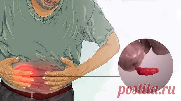 Первые симптомы и признаки аппендицита - ПолонСил.ру - социальная сеть здоровья - Медиаплатформа МирТесен Аппендицит может начаться в самый неподходящий момент: во время похода или круиза в открытом море. Главное при этом - вовремя узнать болезнь и обратиться за помощью к врачу. Что это такое? Аппендицит – это острое воспаление придатка слепой кишки, также известного как аппендикс (рис. 1). Рисунок 1. - 17 января - 43973306594 - Медиаплатформа МирТесен