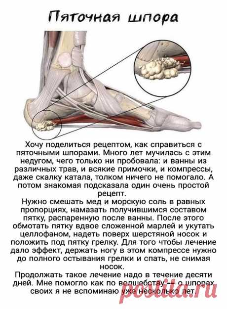 Пяточная шпора