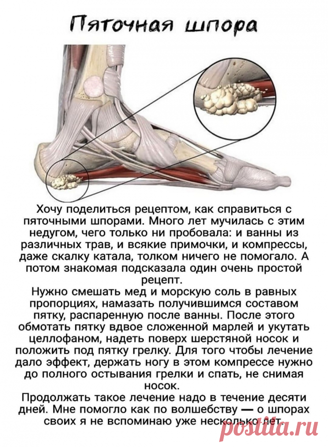 Пяточная шпора