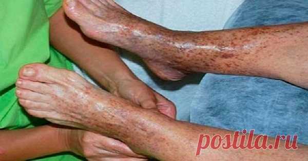 Эффективные советы, чтобы решить проблему плохого кровообращения