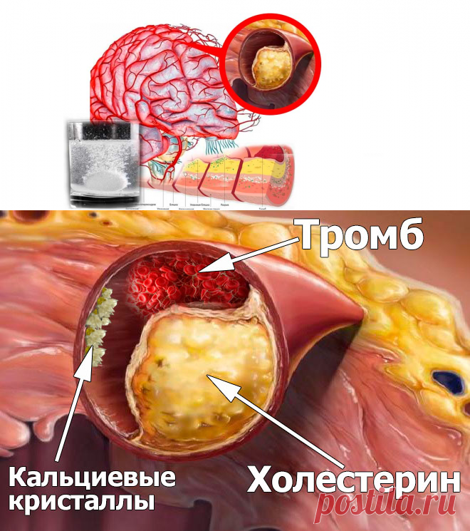 После такой чистки сосудов проходит гипертония и ещё 9 якобы «неизлечимых» заболеваний