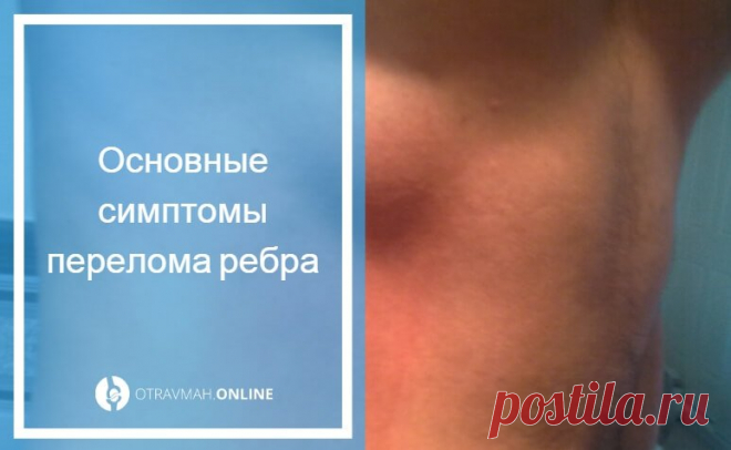 Что делать если сломано ребро - как лечить