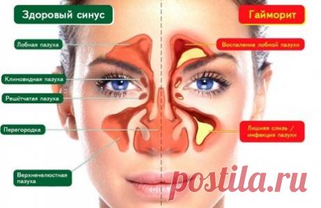 Лечим за копейки гайморит и не только!