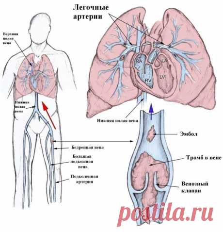 ПРОФИЛАКТИКА ОБРАЗОВАНИЯ ТРОМБОВ