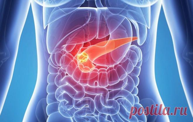 Что такое острый панкреатит Острый панкреатит – неожиданное воспаление поджелудочной. Обычно после этого эпизода работа железы восстанавливается. Типичным фактором риска острого панкреатита являются камни в желчном пузыре. Характерный симптом этого болезненного состояния — боль в животе.