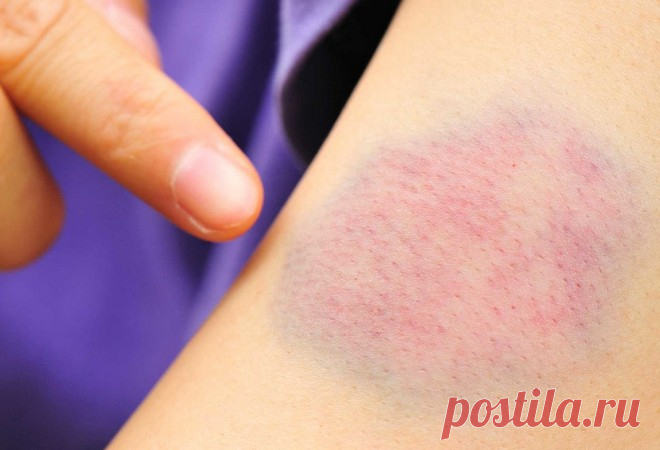 Почему появляются синяки на руках: без причины, удара, гематомы Почему появляются синяки на руках или ногах без причины, удара, серьезной травмы. Основная причина авитаминоз, стенки сосудов становятся хрупкими, лопаются, как следствие появляются кровоподтеки и целые гематомы