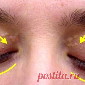 Если вы заметили такие наросты - это повод незамедлительно посетить врача!