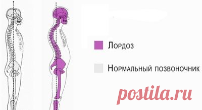 Лордоз позвоночника — что это такое, лечение физиологического лордоза Лордоз – это физиологический или патологический изгиб позвоночника с выпуклостью вперед. В норме он есть у всех людей в шейном и поясничном отделе. В отличие от физиологического, для патологического лордоза характерный выраженный изгиб. Это приводит к изменению осанки и боли в спине. Лечение может