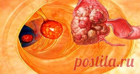 99% болезней, включая рак, можно было бы избежать, если бы люди знали об этом Очищения кишечника является очень важной процедурой. Кишечник способствует усвоению питательных веществ, а главное – выводит токсины из организма. При нарушении функций кишечника паразиты и остатки пищи могут попасть в кровь и лимфу, вызывая разные проблемы со здоровьем: воспаление, инфекции, аллергию, угри, запоры, артрит, ревматизм, астму, проблемы с сердцем и дыханием, усталость, депрессия, от...