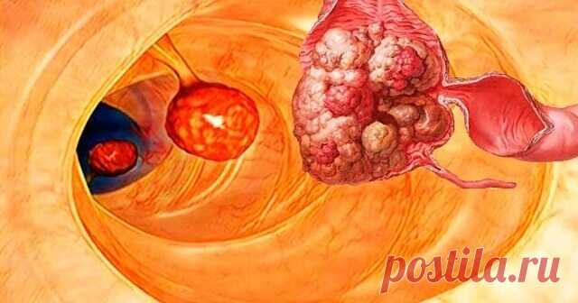 99% болезней, включая рак, можно было бы избежать, если бы люди знали об этом Очищения кишечника является очень важной процедурой. Кишечник способствует усвоению питательных веществ, а главное – выводит токсины из организма. При нарушении функций кишечника паразиты и остатки пищи могут попасть в кровь и лимфу, вызывая разные проблемы со здоровьем: воспаление, инфекции, аллергию, угри, запоры, артрит, ревматизм, астму, проблемы с сердцем и дыханием, усталость, депрессия, от...