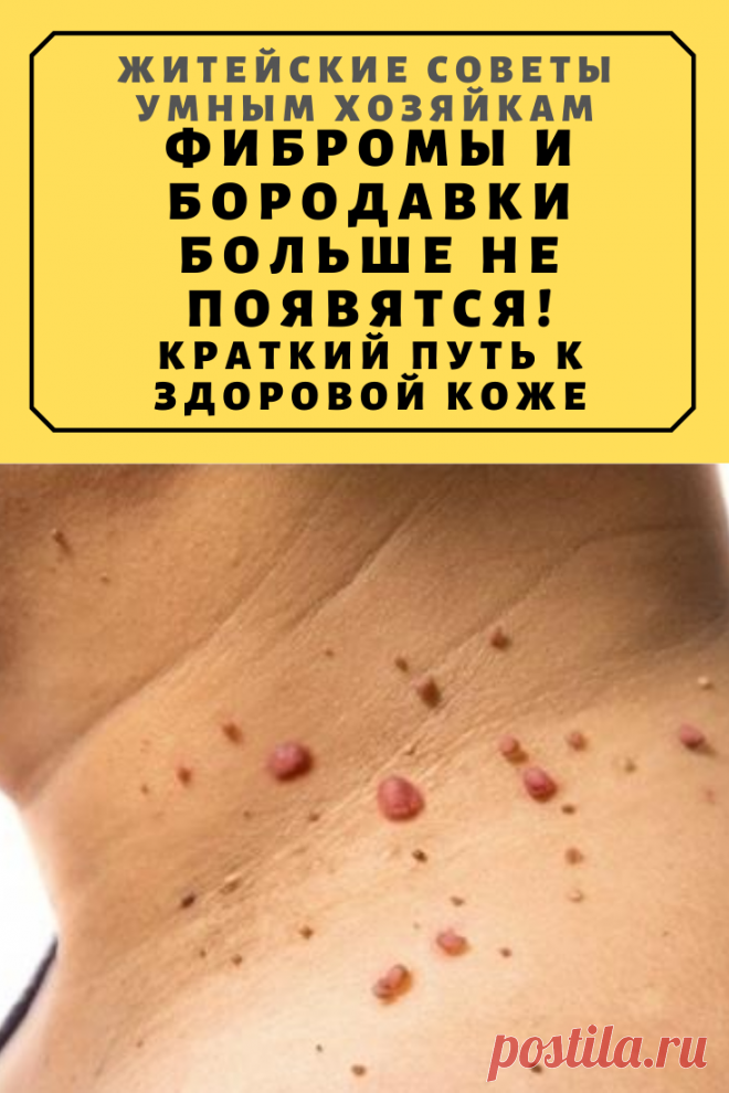 Фибромы и бородавки больше не появятся! Краткий путь к здоровой коже | Житейские Советы