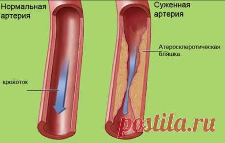 Народные методики для очищения сосудов