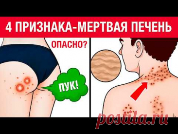 6 главных признаков УМИРАЮЩЕЙ ПЕЧЕНИ! Как быстро проверить здоровье печени?