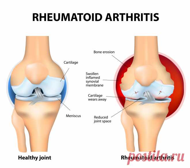 Лечение артрита в Германии | Лечебная артроскопия