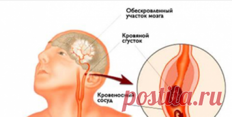 ИНСУЛЬТ: Запомните всего 3 первых шага, чтобы спасти себе и близким жизнь!