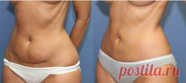 ПОДСЛУШАНО У ДИЕТОЛОГА: Избавляемся от свисающих боков и лишнего веса за 21 день. | Подслушано у диетолога | Яндекс Дзен