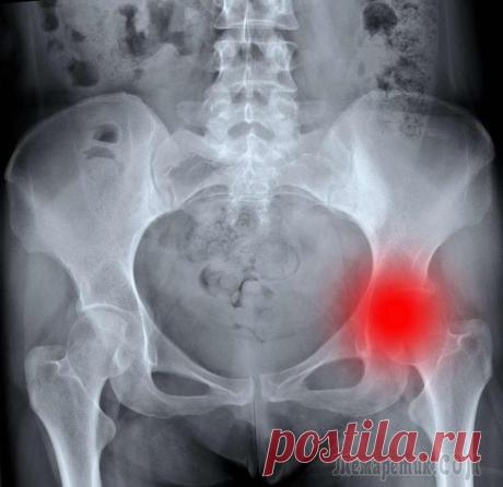 Рак костей – симптомы, признаки, стадии, диагностика и лечение