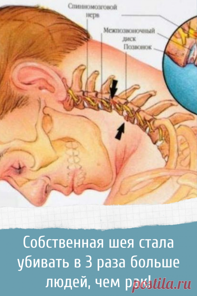 Собственная шея стала убивать в 3 раза больше людей, чем рак!