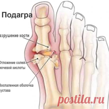 ХИЖИНА ЗДОРОВЬЯ. Подагра или наросты на костях