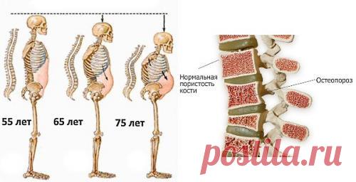 Диета и особенности рациона питания при остеопорозе. Основные советы по питанию больным остеопорозом Более подробно о питании пациентов с остеопорозом можно прочитать в соответствующей статье . Здесь мы напомним об основных рекомендациях: ...