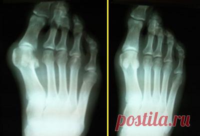 Косточки на ногах - Хирургия - бесплатная консультация врача-хирурга - отвечает Лагодич Леонид Григорьевич - Здоровье Mail.Ru