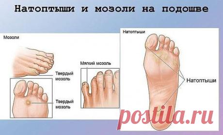 Натоптыши