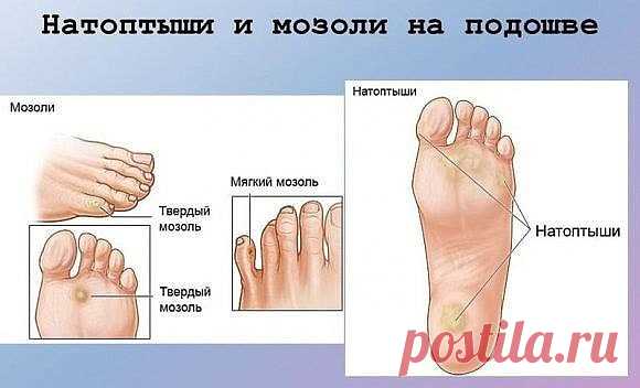 Натоптыши