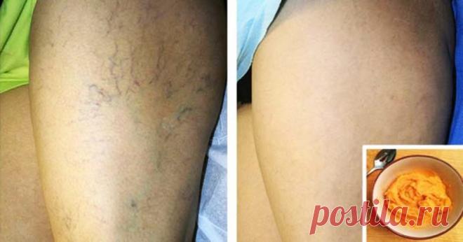 Удали сосудистую сетку! Это средство сделает Ваши ножки идеально красивыми! Смотрим ВИДЕО