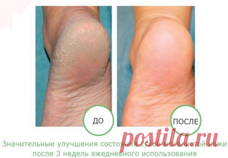 Трещины на пятках и их лечение