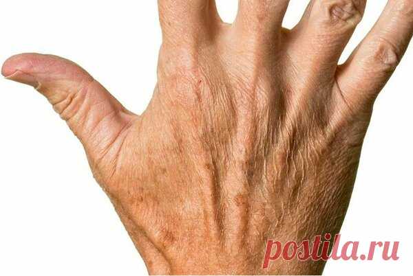Как избавиться от сухости и пигментных пятен на руках: пошаговый рецепт | 50+ | Яндекс Дзен