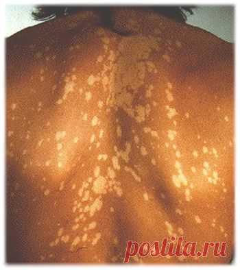 Почему появляются белые пятна на коже после загара?