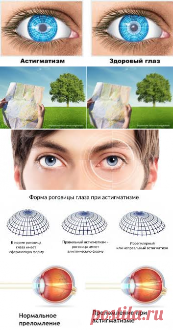 Астигматизм – это разновидность аномалии рефракции глаза, которая характеризуется различной силой преломления лучей по двум главным меридианам. У пациента зрение становится нечетким в результате искривления роговицы, реже – хрусталика.