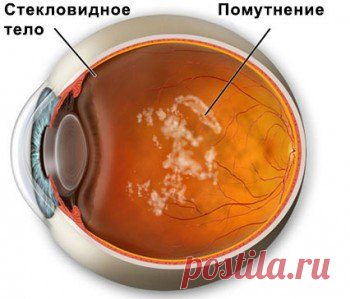 МУШКИ ПЕРЕД ГЛАЗАМИ ПРИ ОСТЕОХОНДРОЗЕ 

Мушки перед глазами – достаточно частая жалоба, с которой обращаются к врачу-офтальмологу, хотя нередко причина их появления кроется в остеохондрозе позвоночника. 

Симптомы 
Часто пациенты с остеохондрозом шейного отдела отмечают, что при рассматривании светлых предметов они видят небольшие кружочки, прозрачные ниточки, точечки, которые словно скатываются вниз по стеклу. Иногда появляется ощущение дымки, при этом существенного ухудш...