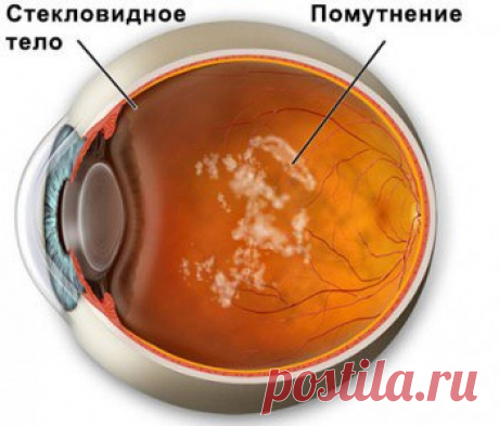 МУШКИ ПЕРЕД ГЛАЗАМИ ПРИ ОСТЕОХОНДРОЗЕ 

Мушки перед глазами – достаточно частая жалоба, с которой обращаются к врачу-офтальмологу, хотя нередко причина их появления кроется в остеохондрозе позвоночника. 

Симптомы 
Часто пациенты с остеохондрозом шейного отдела отмечают, что при рассматривании светлых предметов они видят небольшие кружочки, прозрачные ниточки, точечки, которые словно скатываются вниз по стеклу. Иногда появляется ощущение дымки, при этом существенного ухудш...