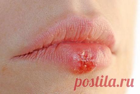 . ГЕРПЕС ПРОСТОЙ - СИМПТОМЫ, ЗАРАЖЕНИЕ, ДИАГНОСТИКА И ЛЕЧЕНИЕ   Обсуждение на LiveInternet - Российский Сервис Онлайн-Дневников