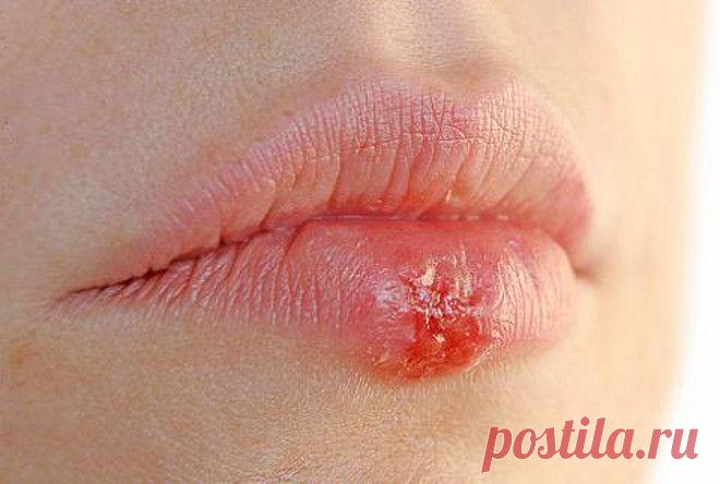 . ГЕРПЕС ПРОСТОЙ - СИМПТОМЫ, ЗАРАЖЕНИЕ, ДИАГНОСТИКА И ЛЕЧЕНИЕ   Обсуждение на LiveInternet - Российский Сервис Онлайн-Дневников