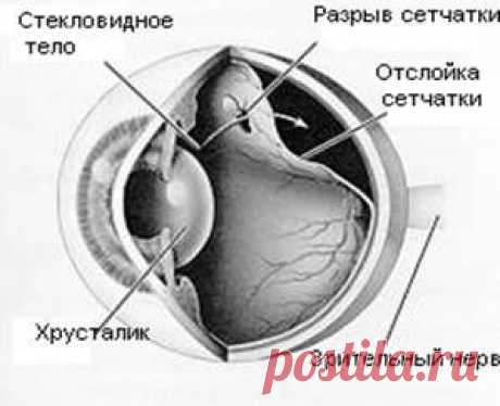 Отслойка сетчатки. Симптомы и лечение отслойки сетчатки