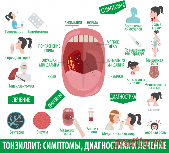 Как вылечить ангину взрослому пациенту? - статьи от компании Еламед