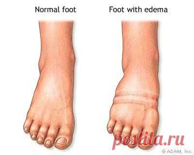 Варикозная болезнь, отек Квинке или проблемы с сердцем? Как различить отеки конечностей?