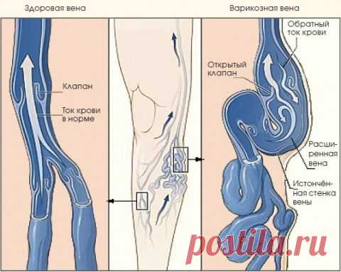 Варикозное расширение вен — психосоматика и лечение
