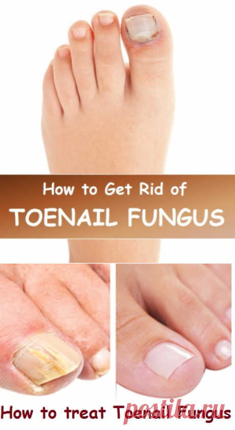 How to Get Rid of Toenail Fungus | Virtual Clinic