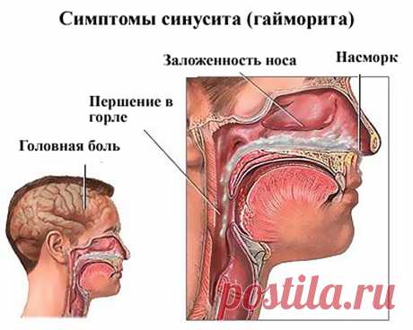 Домашняя мазь для лечения гайморита - Журнал для женщин Натурально и эффективно! * Берем в равных пропорциях мед, растительное масло (лучше подсолнечное) и водку. * Измельчаем блендером хозяйственное мыло и репчатый лук (в таких же пропорциях, как и предыдущие компоненты). * Тщательно перемешиваем и нагреваем на водяной бане. * Однородную массу остужаем до комнатной температуры, наносим на на ватную палочку и вводим мазь в […]