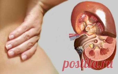 Есть проблемы с камнями в почках? Здесь вы найдете способ естественного очищения почек!