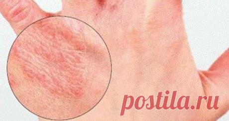 Как выглядит дерматит на руках: фото, причины заболевания
