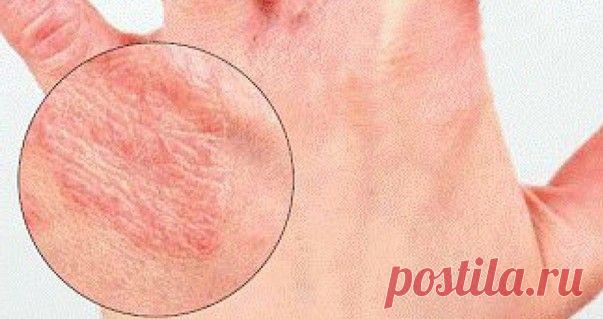 Как выглядит дерматит на руках: фото, причины заболевания
